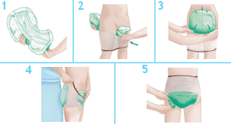 Pose du Moliform